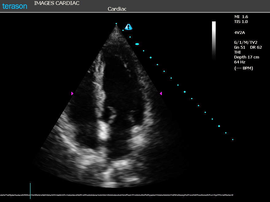 terason cardiac ultrasound image